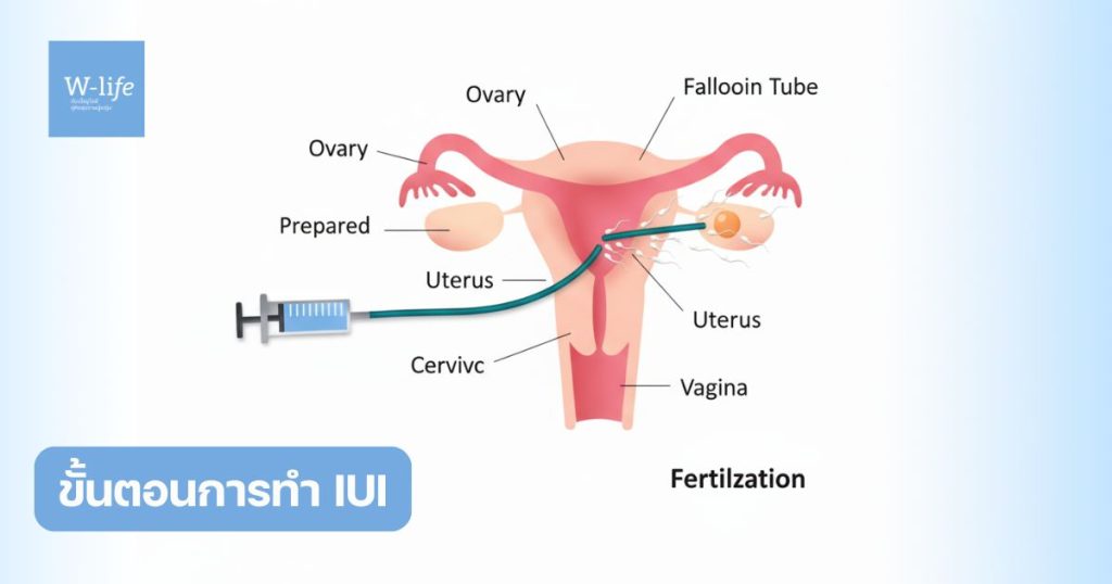 ขั้นตอนการทำ IUI