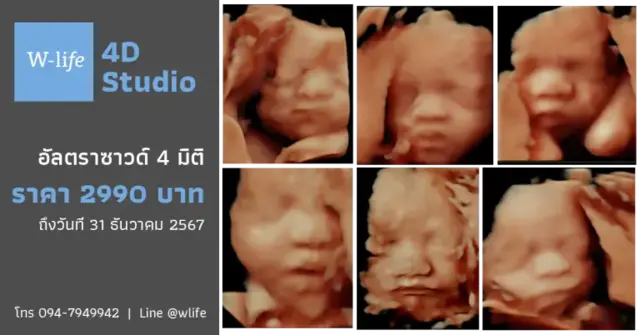 แพคเกจอัลตราซาวด์ 4 มิติ