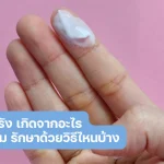 ตกขาวไม่หายสักที ตกขาวเรื้อรัง